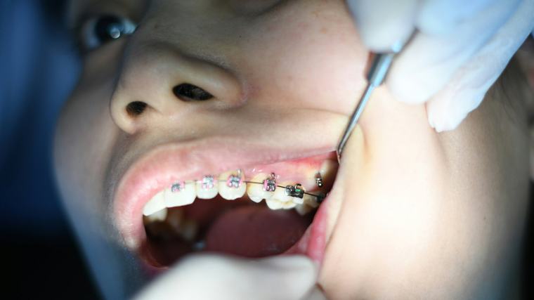 België gaat kosten voor orthodontie beperken via het systeem van de maximumfactuur