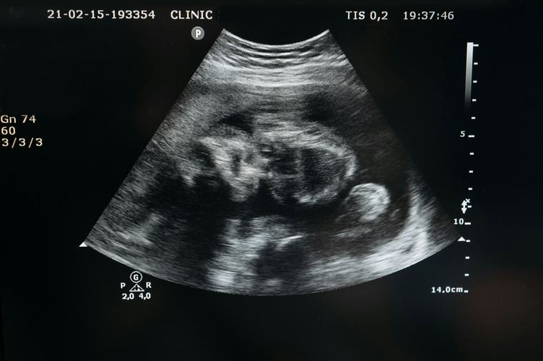 Eerste Britse baby geboren na transplantatie van baarmoeder van overleden donor